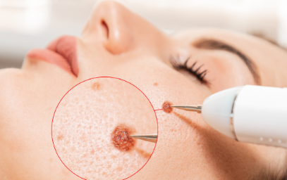 Lentigo Gone in One Go: My Mirae’s Game-Changing Laser