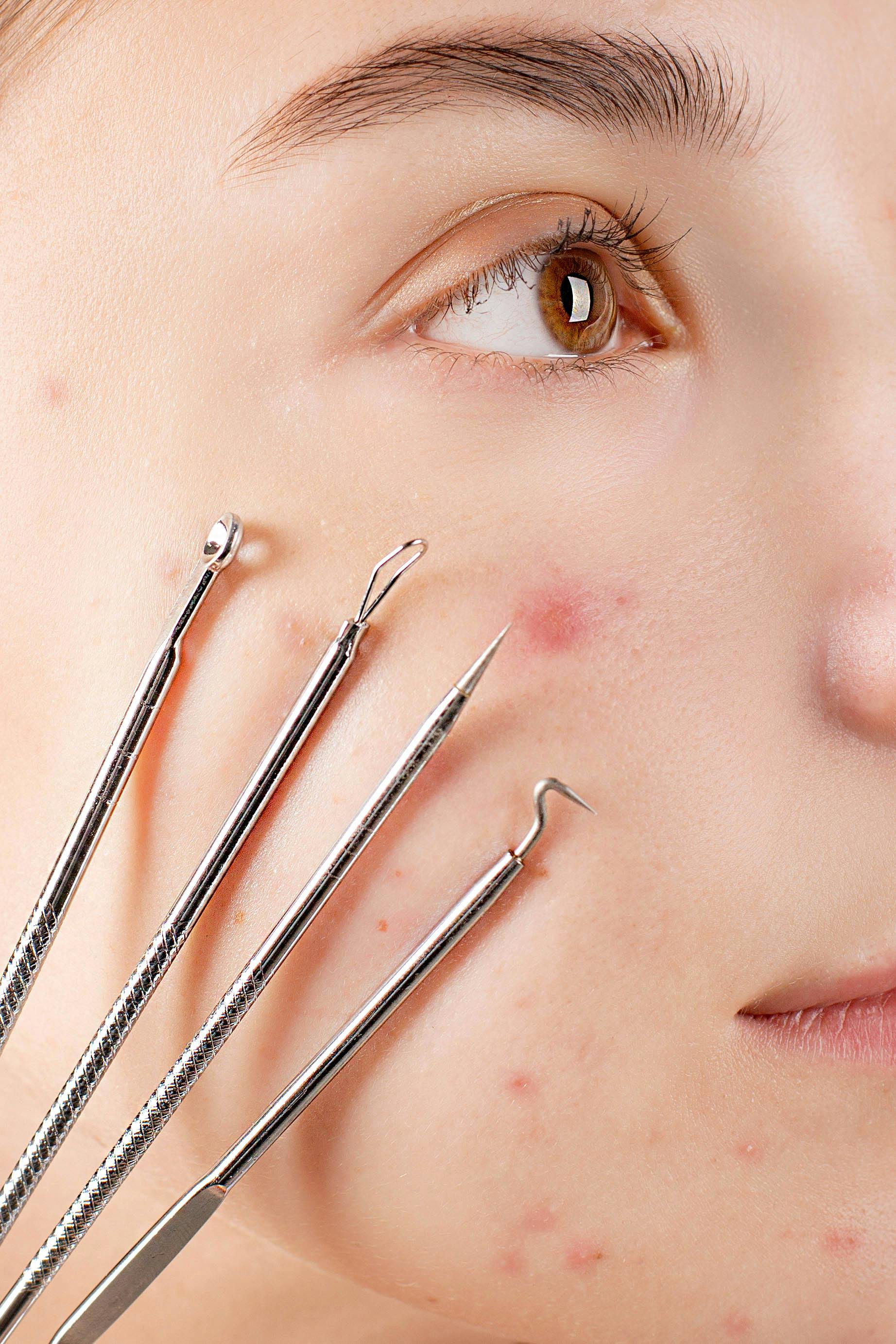 Stop Struggling With Acne Scars—Benjamin Clinic’s Cutting-Edge Lasers Have You Covered
